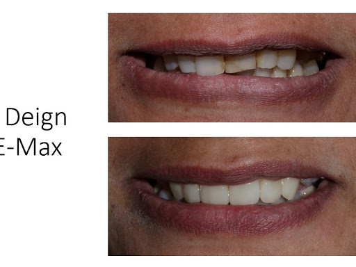 #Smiledesign#emax#dentistinjuhapura#dentistinahmedabad#dentistnearme post image