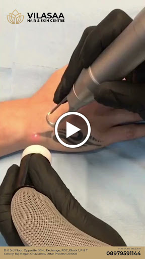 Best Tattoo Removal Centre in Ghaziabad – Vilasaa Hair and Skin Centre, RDC