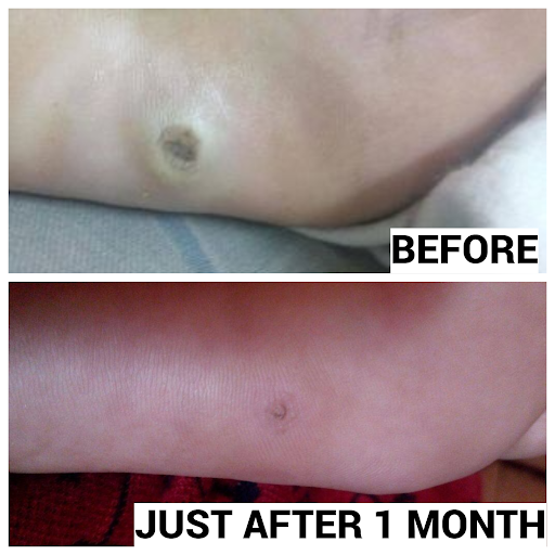 A case of Chronic Painful Plantar Wart cured completely in 2 months. Immediate symptomatic relief… post image
