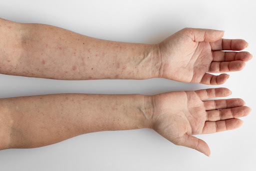 Since many skin conditions can look similar, a proper evaluation is important to understand the u… post image