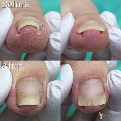 川越巻き爪補正店