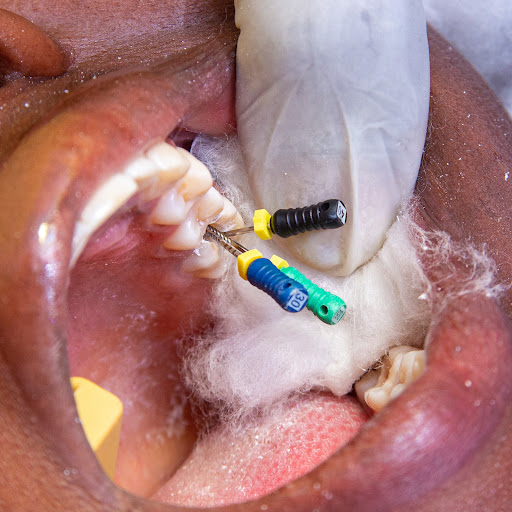 Root canal treatment eliminates deep pulp infection, preserves natural tooth structure, and allev… post image