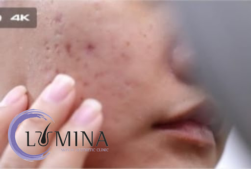 Expert Acne Treatment in Jaipur for Clear, Healthy Skin

Str