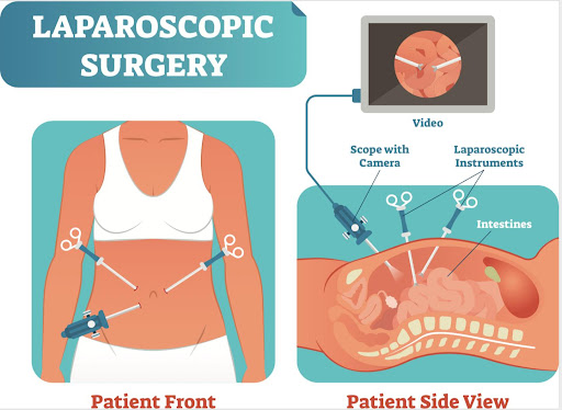 A patient experiencing hernia-related discomfort, swelling, and difficulty in daily activities re… post image