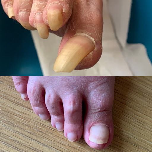 Family Foot Health - Steeple Bumpstead - Nikki