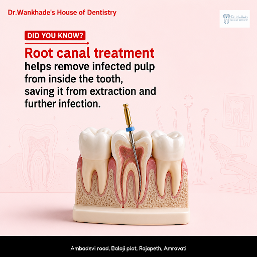 Dr. Wankhade's House of Dentistry offers expert root canal treatment and comprehensive dental car… post image