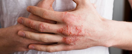 Struggling with eczema, dry skin, itchy rashes, or hand derm