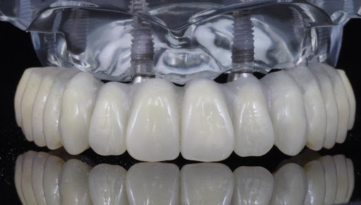 Estética Dental e Implantologia