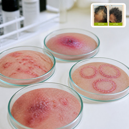 Skin infections are common in Kalyan’s climate, but timely care from the right skin specialist ma… post image