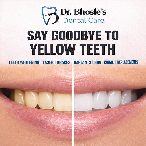 At Dr. Bhosle’s Dental Care, we provide safe and effective professional teeth whitening along wit… post image