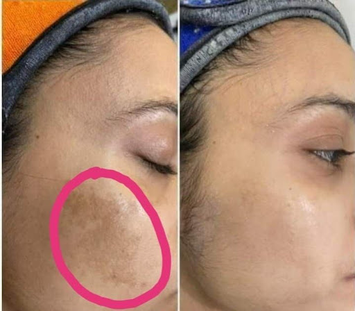 Best Cosmetologist In Mansarovar

#LUMINASKIN&AESTHETICCLINI