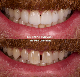 Photo n°26 de Dr. Ralph BADAOUI ✾ Chirurgien Dentiste | Esthétique du sourire & Réhabilitations complexes | Paris à Paris (Urgences dentaires)