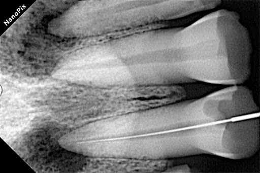 Painless dentistry utilizes modern techniques like laser technology, computerized anesthesia deli… post image