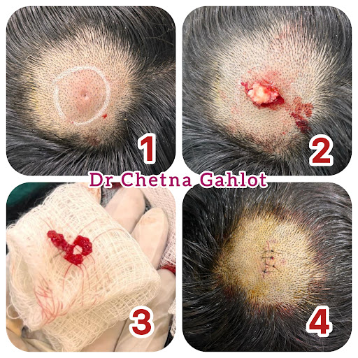 A pilar cyst, also known as a trichilemmal cyst, is a benign, keratin-filled cyst that typically… post image
