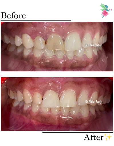 Aesthetic Crowns: Because Your Smile Deserves a Second Chance ✨🦷