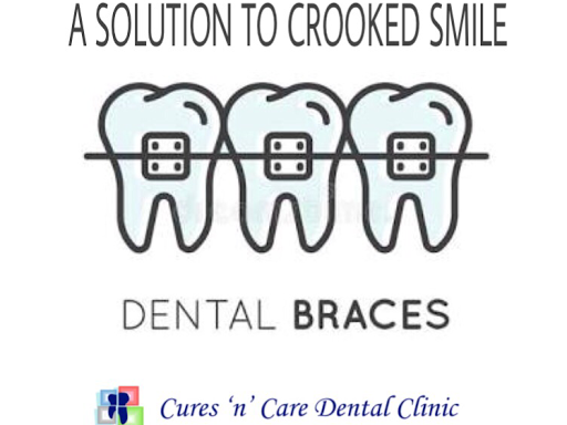 Free Braces consultation  and 10% off on orthodontic treatment under Specialised and skilled team…