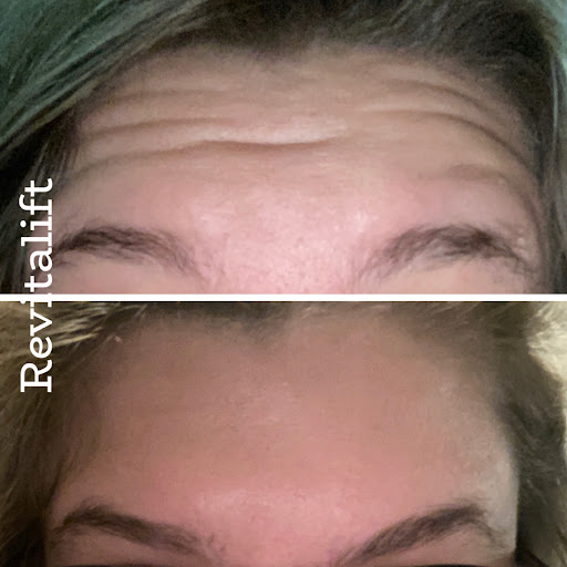 Revitalift Aesthetic Center