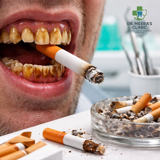 Smoking doesn’t just affect your lungs – it silently damages your gums, teeth, and smile. At Dr.… post image