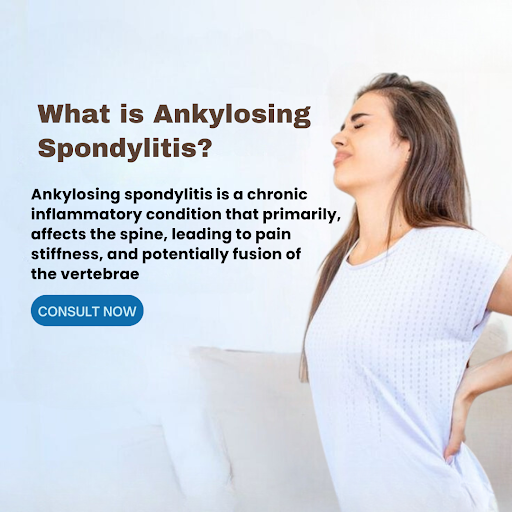 Ankylosing spondylitis is a chronic inflammatory condition primarily affecting the spine, leading…