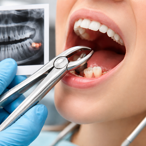 Are your wisdom teeth causing pain, swelling or repeated infections? At Dr. Urvi's Dental Hub in…