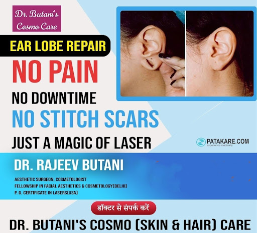 👂Ear lobe repair / 👂कान के कटे छेद भरवाए लेसर से, दर्द रहित चुटकियों मे post image