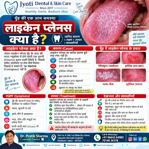 🦷 मुँह में सफेद जालीदार निशान दिख रहे हैं? इसे नजरअंदाज न करें! post image