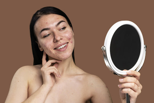 Pimples may appear as whiteheads, blackheads, or inflamed bumps on the face, chest, or back. Whil… post image