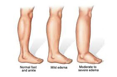 ABC Lymphedema Clinic