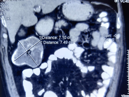 A 7 cm large tumor in Colon ( large intestine). Patient underwent laparoscopic radical hemicolect…