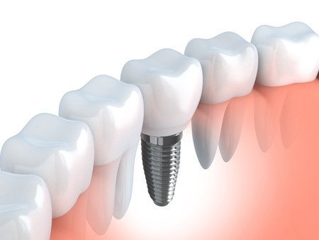 Dental Practice Barkingside - Thumbnail