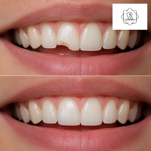 Chipped or slightly cracked teeth can make you hide your smile, but they’re often easier to fix t… post image
