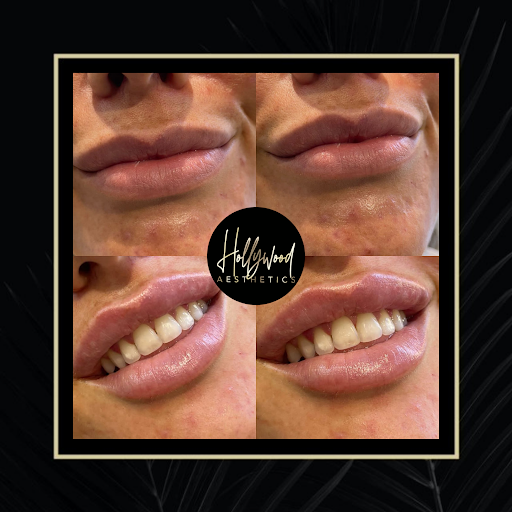 Hollywood Aesthetics - Thumbnail