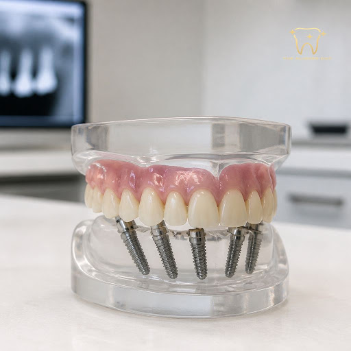 Thinking about a long-term solution to replace all missing or failing teeth? All-On-4 full arch i… post image