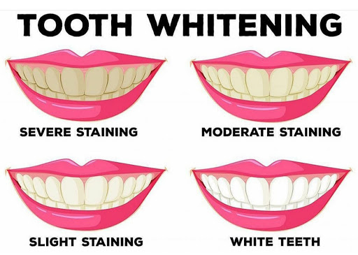 Crissnclear Teeth Whitening