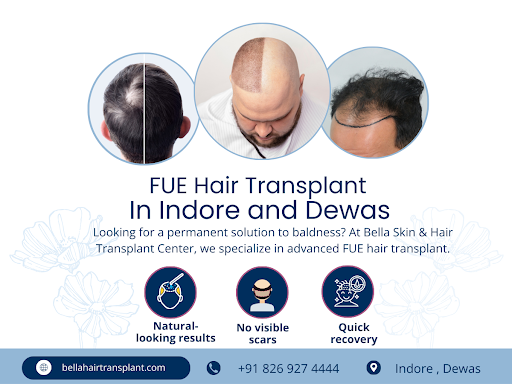 Best FUE Hair Transplant in Indore & Dewas post image