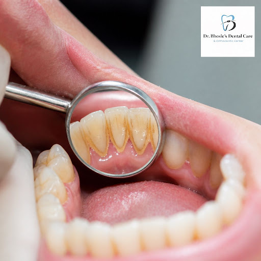 Healthy gums are the foundation of a confident smile. Regular dental scaling removes stubborn pla… post image