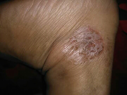 Cured within 2 weeks (Dr Soumya Dey's Clinic desk)  post image