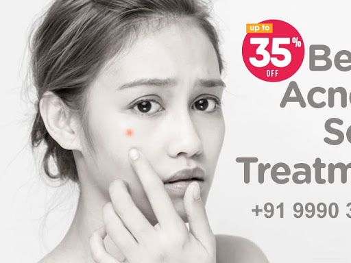 Permanent Acne Scars Treatment. #BestAcneScarsTreatment in Faridabad. 100% Satisfaction. 35% Off.… post image