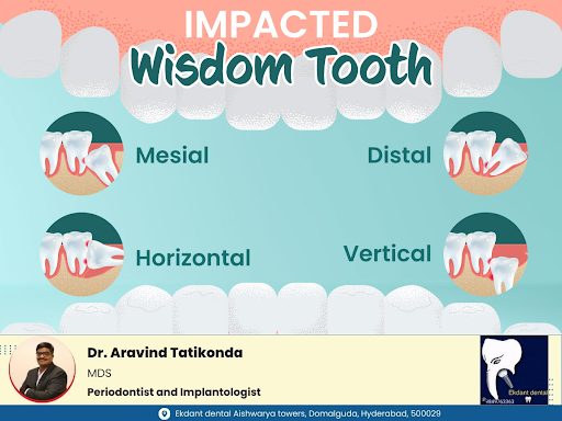 Impacted Wisdom Tooth post image