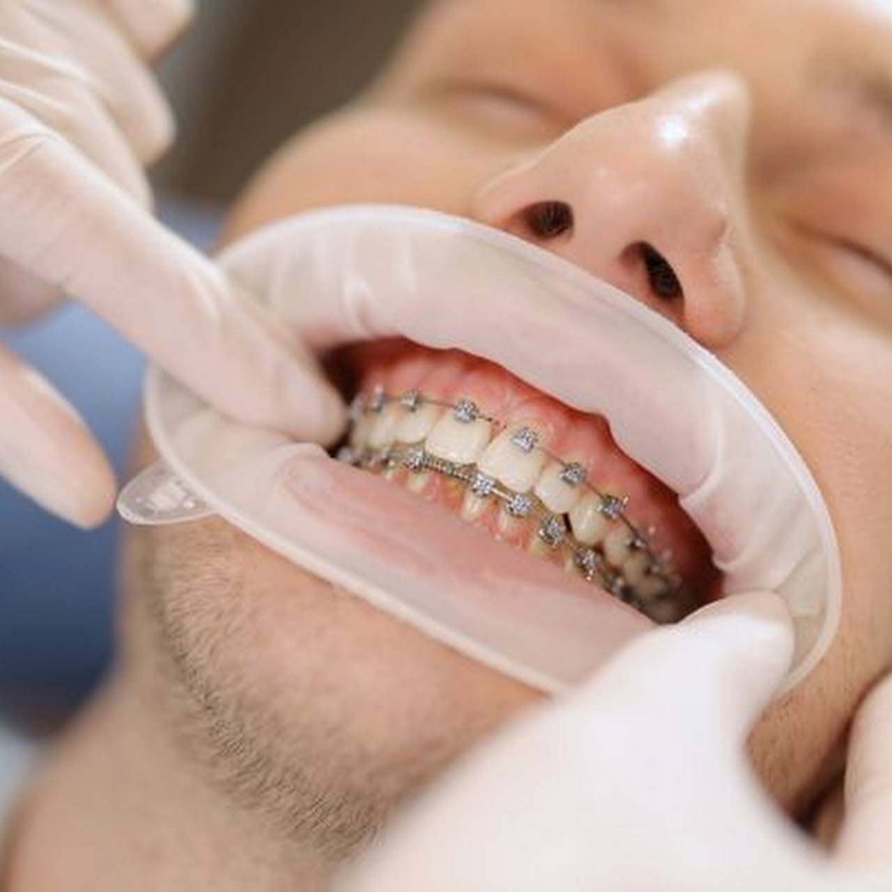 Which Orthodontic Treatment is Right for Me? - Auburn Dentist