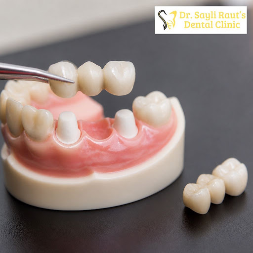 Missing a tooth and worried about your smile or chewing comfort? At Dr Sayli Raut Dental Clinic,…