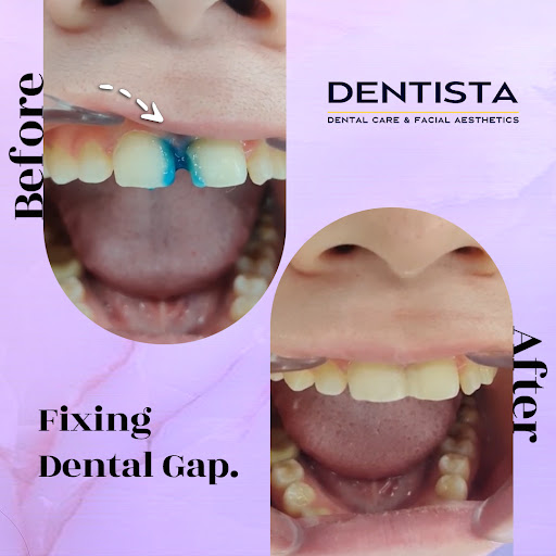 Are you self-conscious about gaps in your teeth? At Dentista, we understand the impact a perfect…
