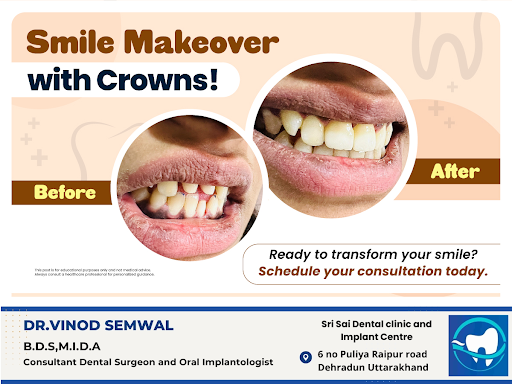 Enhance your smile with dental crowns! Crowns are a great solution for restoring damaged or disco… post image