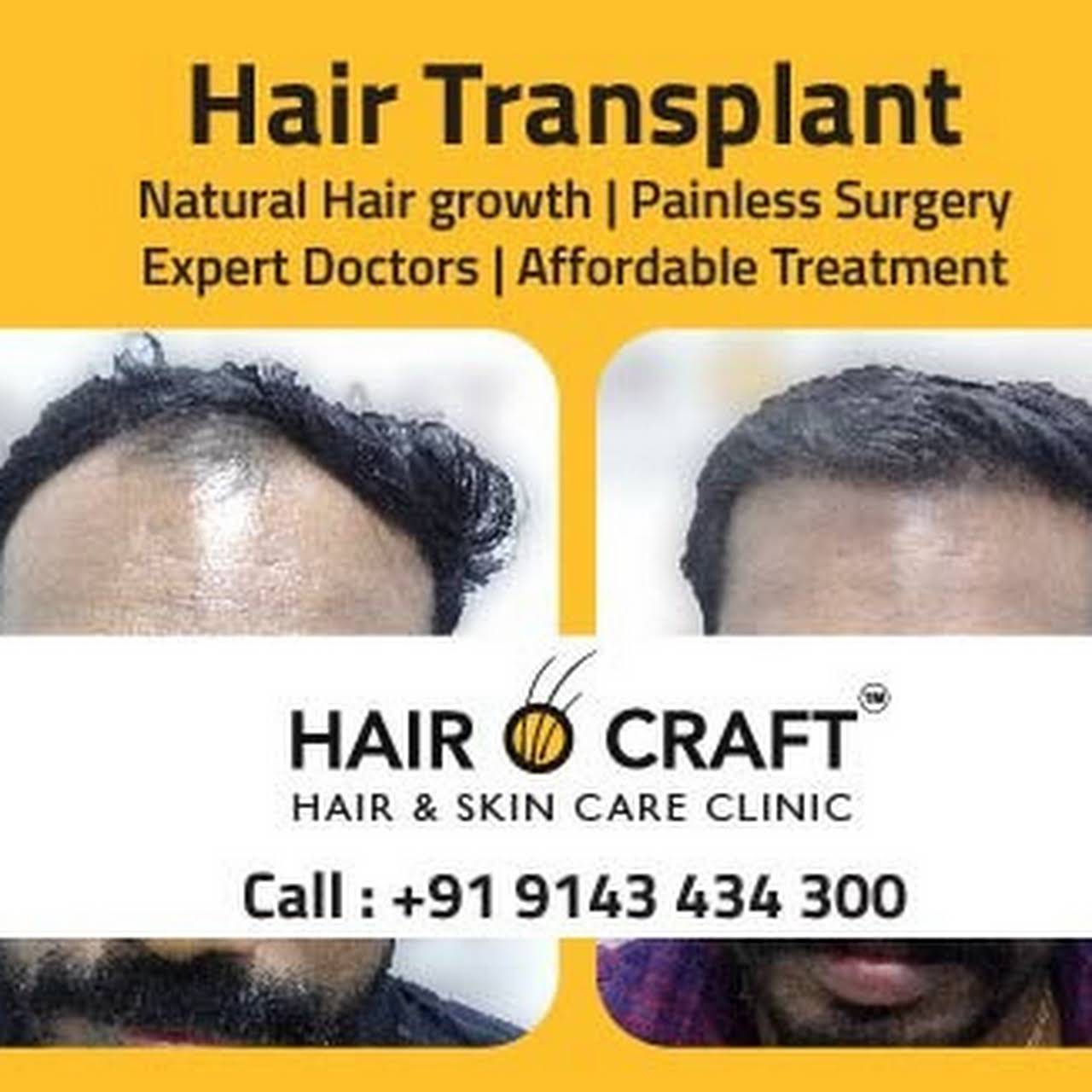 Hair O Craft Hair Transplant Clinic Trivandrum Hair Transplantation Clinic In Trivandrum