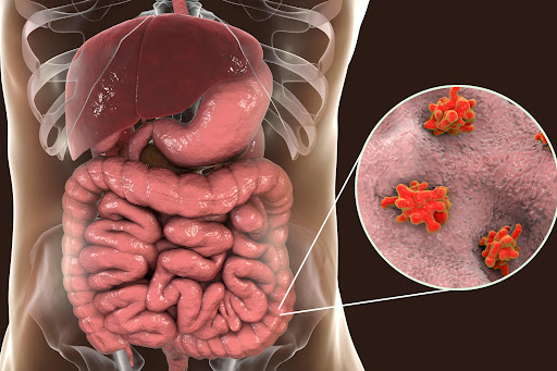 A clear assessment helps understand the possible triggers of dysentery, such as contaminated food…