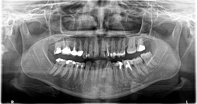 Grafi Dentare ENSI