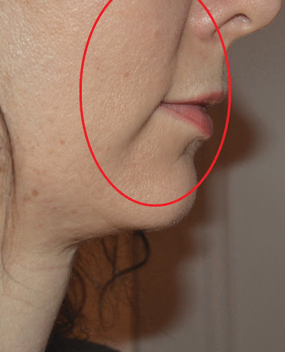 Cosmetic acupuncture and skin needling Melbourne - Thumbnail