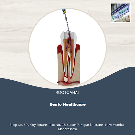 "Say goodbye to toothache with Dento Healthcare's expert Root Canal treatment in Navi Mumbai! Our… post image