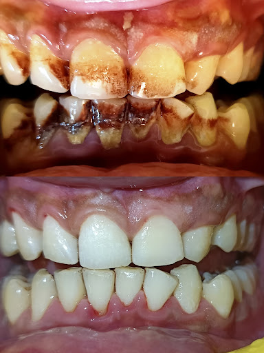 50% discount on your tooth cleaning before NAVRATRI post image