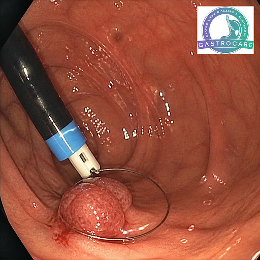 Early detection and timely treatment of gastrointestinal lesions can prevent serious complication… post image